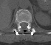 1670566776560770.png 术后ct1.png